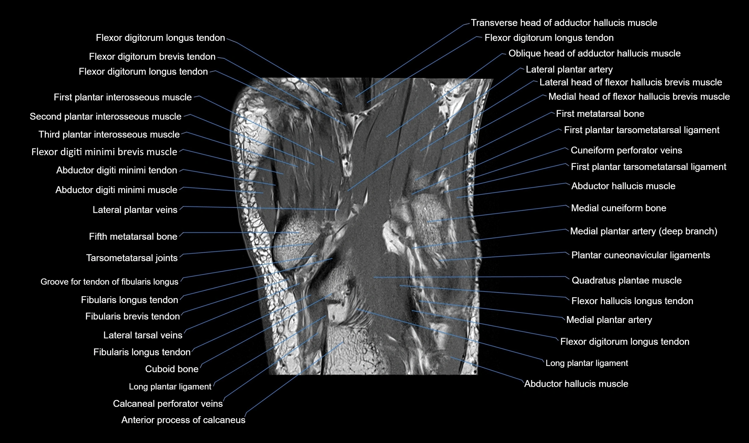 MRI mid foot coronal ligaments cross sectional anatomy 3T  radiology  image-img-00001-00029.webp